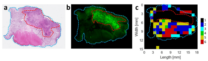 Tumor-and-tissue